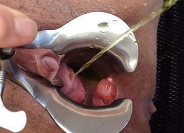 SPECULUM AND PEE