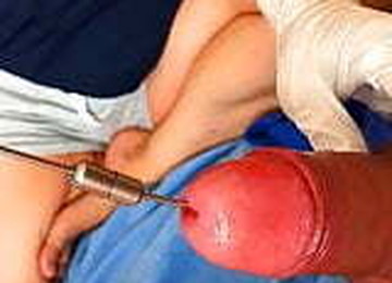 My Wife Inserts A Long Urethra-chain Into My Bladder