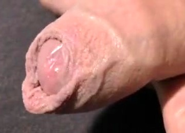 Foreskin Playing 264